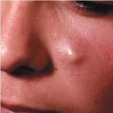 epitelioma