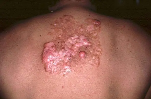 cancer