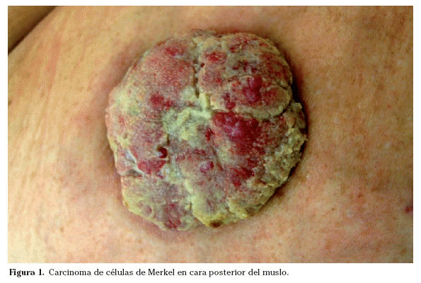 melanoma