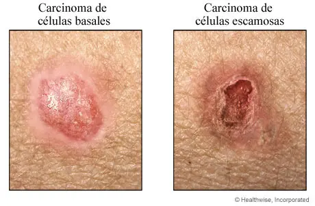 sarcoma