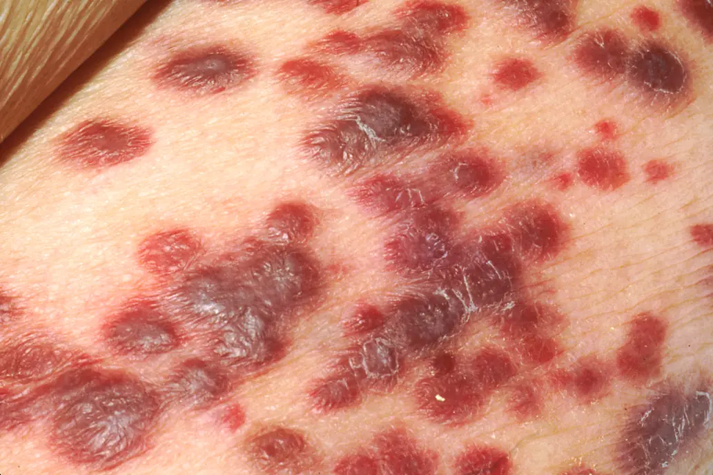 epitelioma