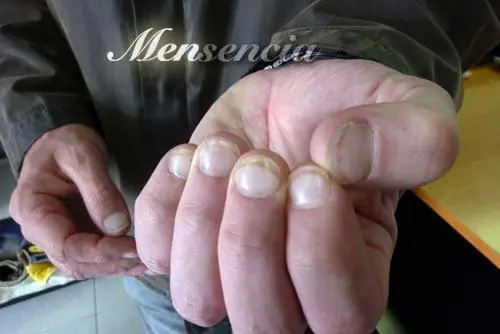 Como dejar de comerse las uñas