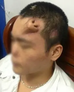 Le implantan una nariz en la frente