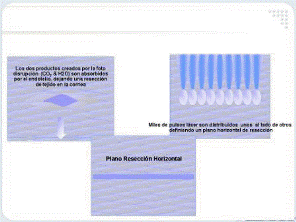 Cirugia refractiva