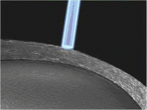 transplante corneal