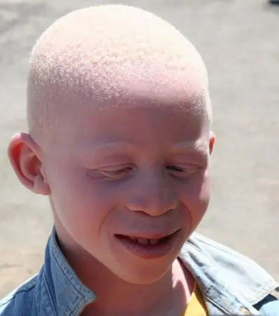 albinos