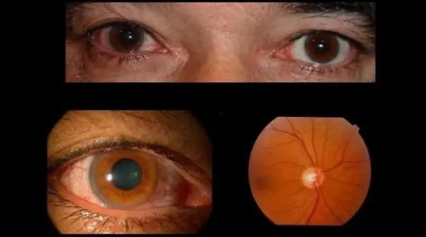Mejora de las lesiones oculares