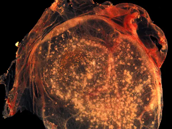 7 infecciones más asesinas