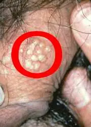 Herpes Genital *ETS*