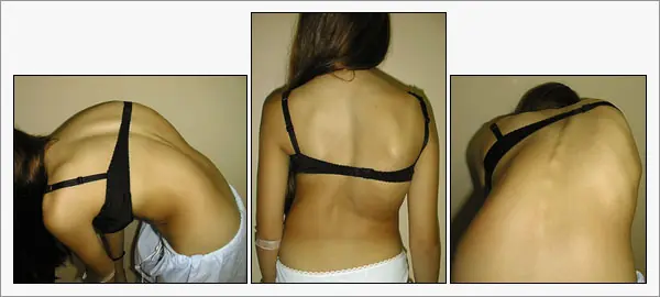 Escoliosis...