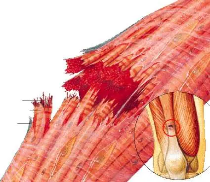 desgarros musculares