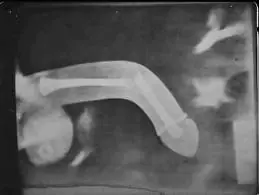 Se te partio el pene y no sabes que hacer? entra y aprende