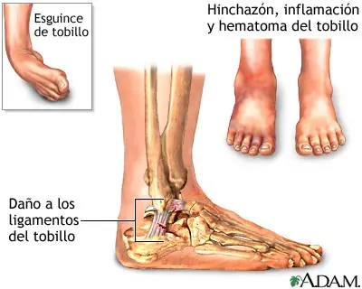 Consejos para tratar una lesión de tobillo