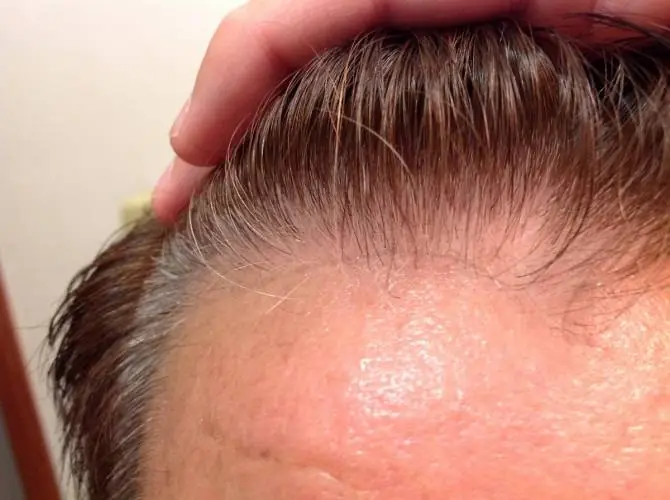 Adiós a los tintes: nuevo tratamiento elimina canas