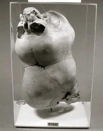 Extrañisima malformacion : Craniopagus Parasiticus