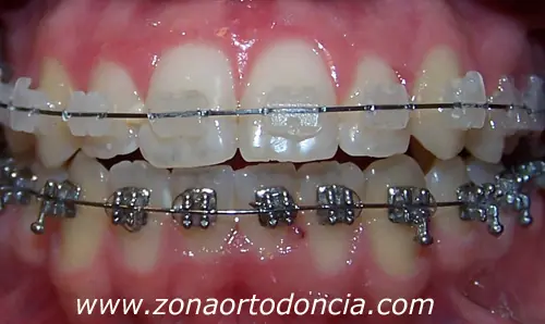 Mi experiencia con los brackets (Actualizable)