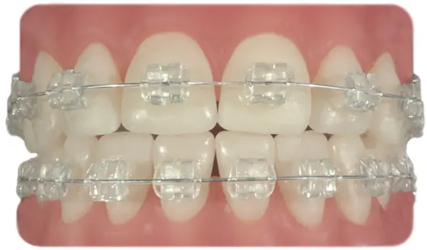 brackets