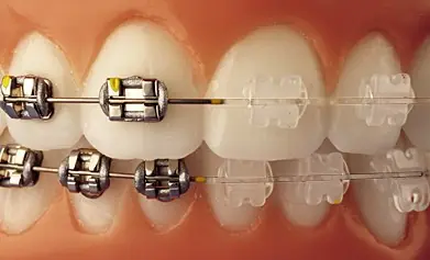Mi experiencia con los brackets (Actualizable)