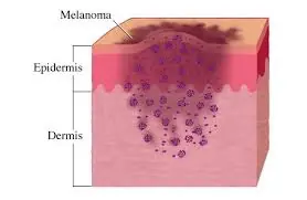 del