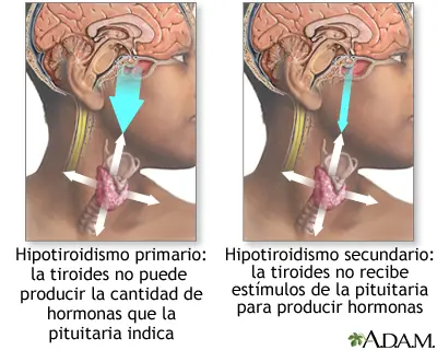 tiroides