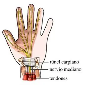tendinitis en la muñeca, que es, como prevenirla?