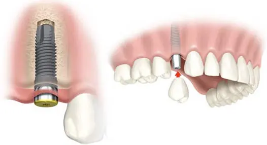Implantes dentales, que son y para que sirven