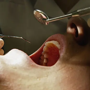 Cáncer Oral(Cancer En La Boca)