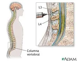 anestesia