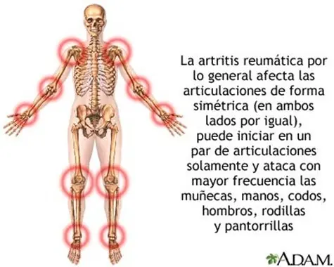 Remedio contra la Artritis.