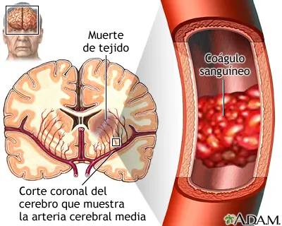 Como prevenir un ACV (Accidente Cerebrovascular)