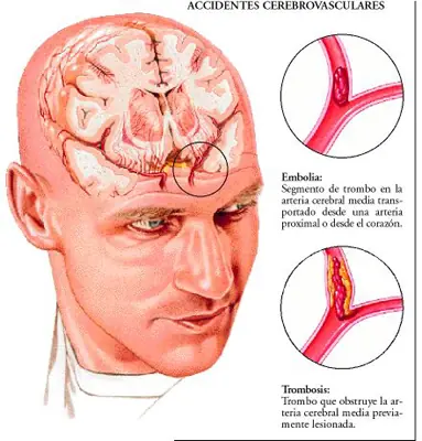 Ataque Cerebral