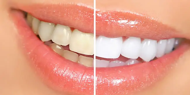 Sencillos consejos para que tengas dientes blancos