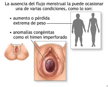 Amenorrea