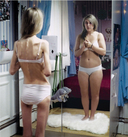 bulimia