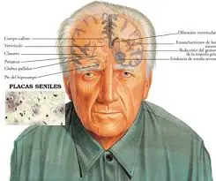 Alzheimer: signos para ayudar a un diagnóstico temprano