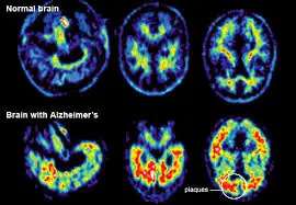 alzheimer