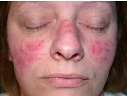 acne severo?:roaccutan es lo mejor [Saca tus conclusiones]