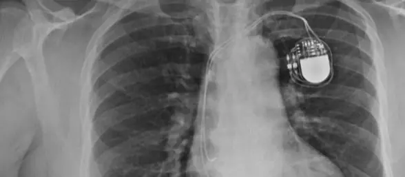 Implantes, vulnerables a 'hackers'