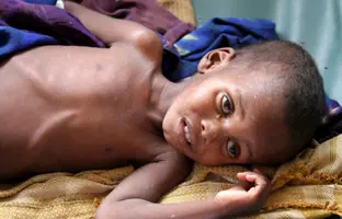 Somalia, uno de cada 10 niños está en riesgo de morir de i