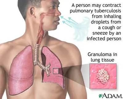 Tuberculosis: el retorno de una asesina