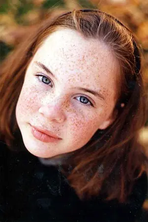 melanoma