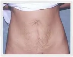 Elimina El Abdomen Después Del Parto