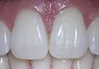 Cómo tener dientes más blancos