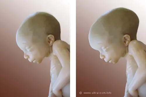 Sorprendentes raras enfermedades y síndromes más extraños