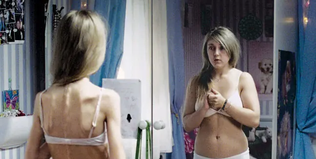 anorexia