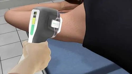 sistema de microondas para eliminar exceso de sudor