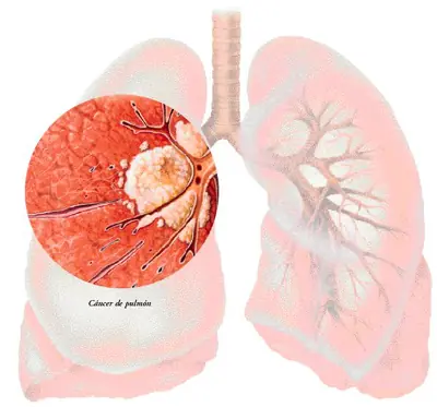 De qué viven las células cancerígenas? Difundelo y ayudem