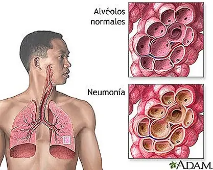 Neumonia - informacion