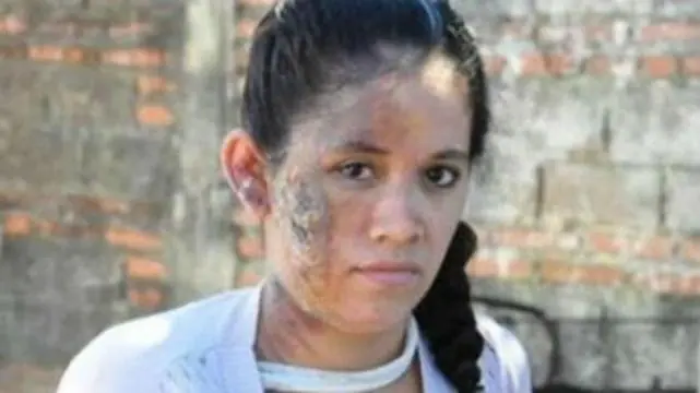 Desmintiendo: Mujer quemada por motochorros