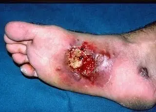 Enfermedades de transimision sexual